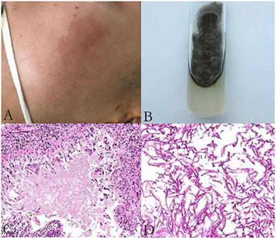 Cerebral Phaeohyphomycosis Caused by Exophiala dermatitidis in a Chinese CARD9-Deficient Patient: A Case Report and Literature Review